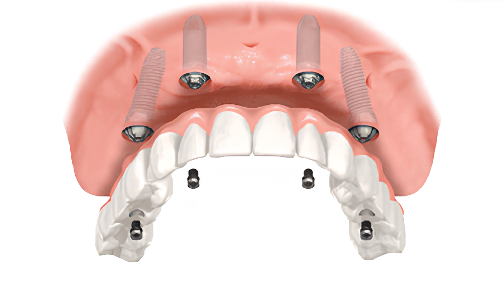 Implant supported Restorations