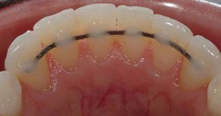Retainers