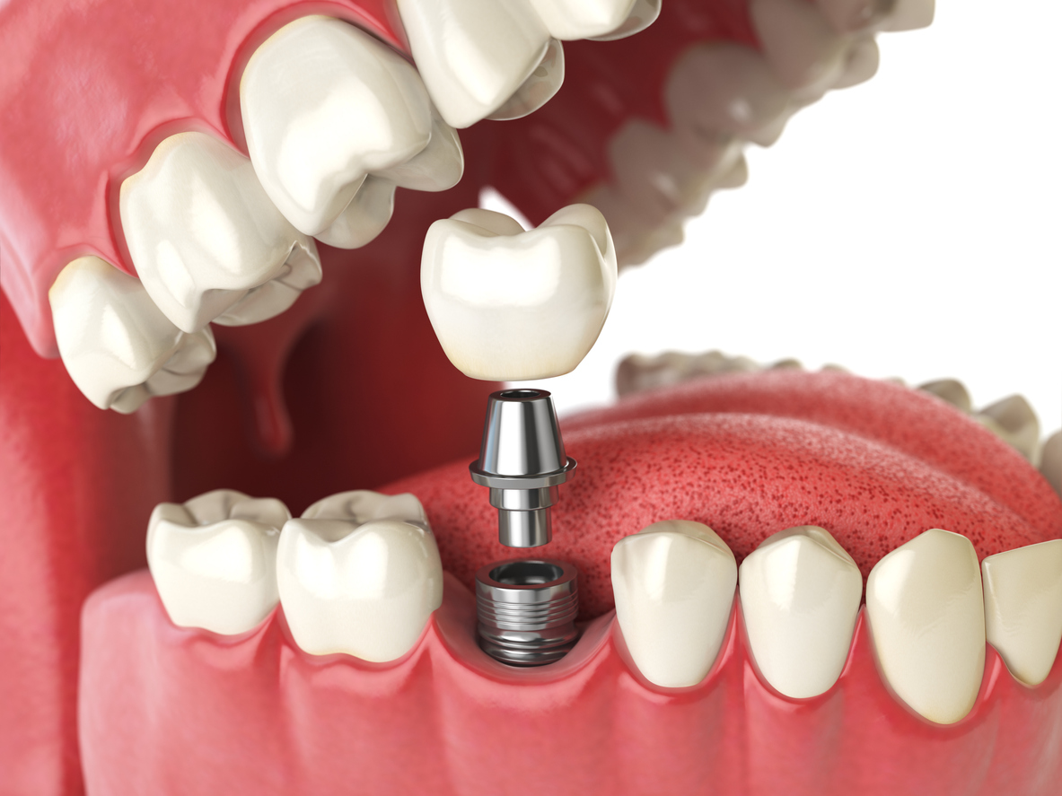 Dental implant procedure and components illustration