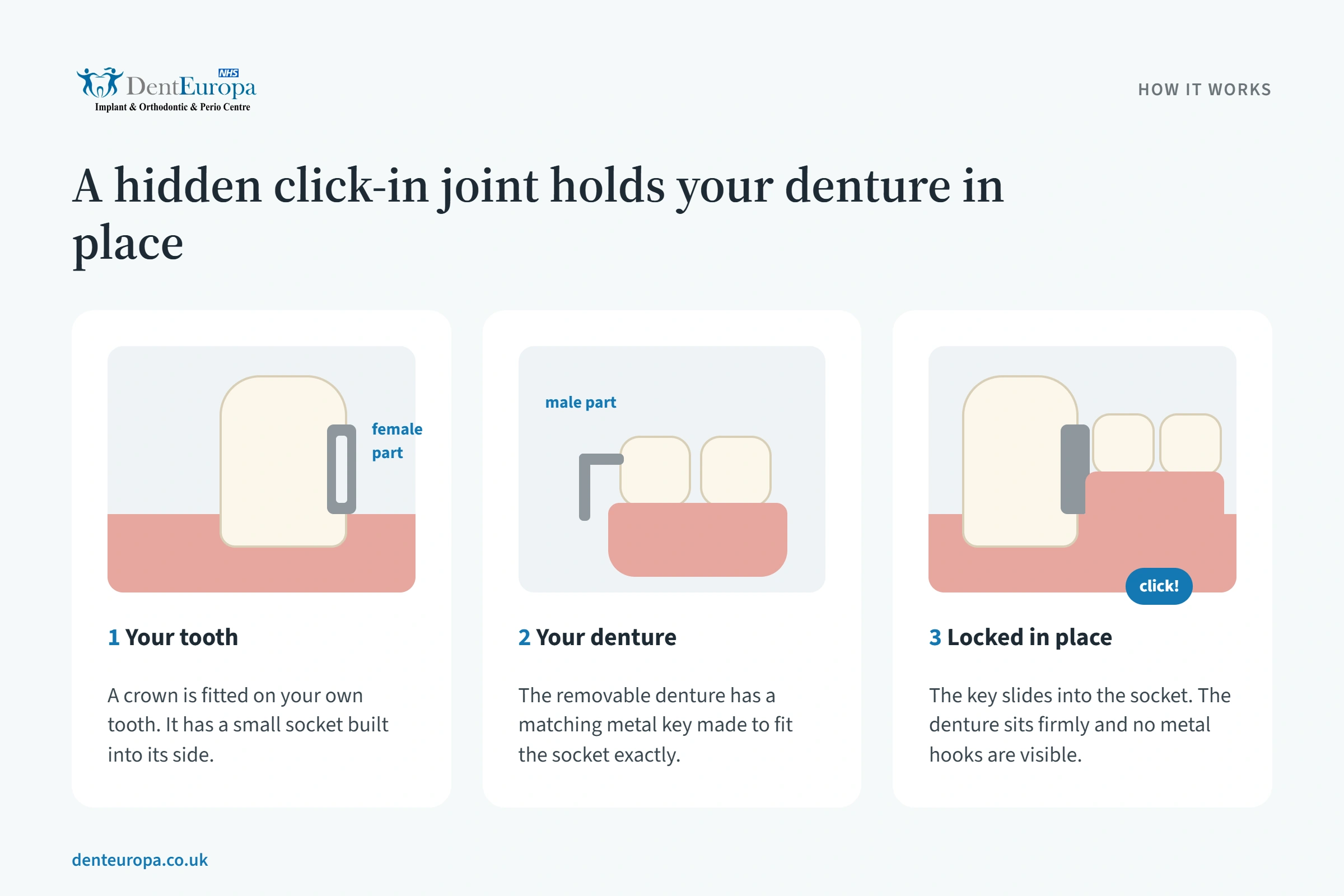 Three-step illustration showing how a hidden attachment holds a denture
