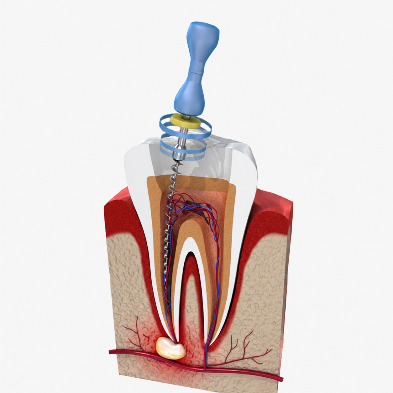 Root canal treatment illustration showing a file inside a tooth
