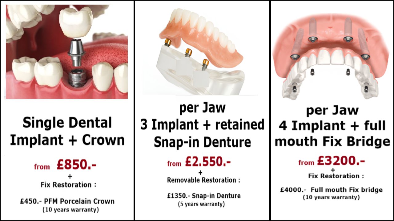 Implant treatment options