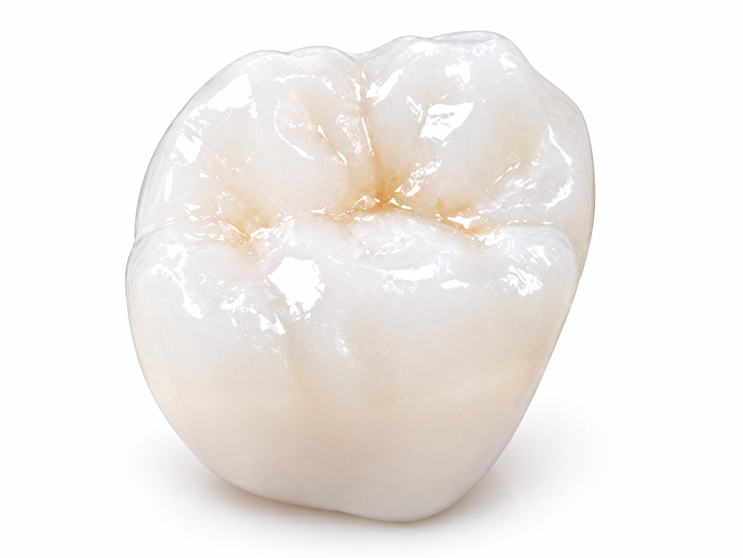 E-max ceramic molar crown