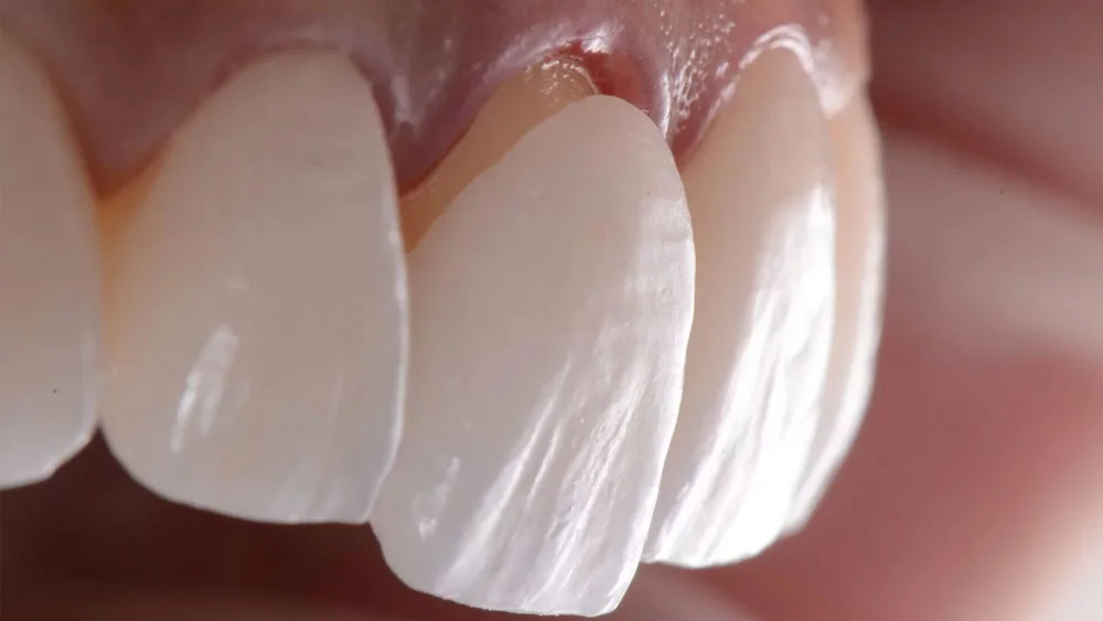 Porcelain laminate veneer positioned on a front tooth
