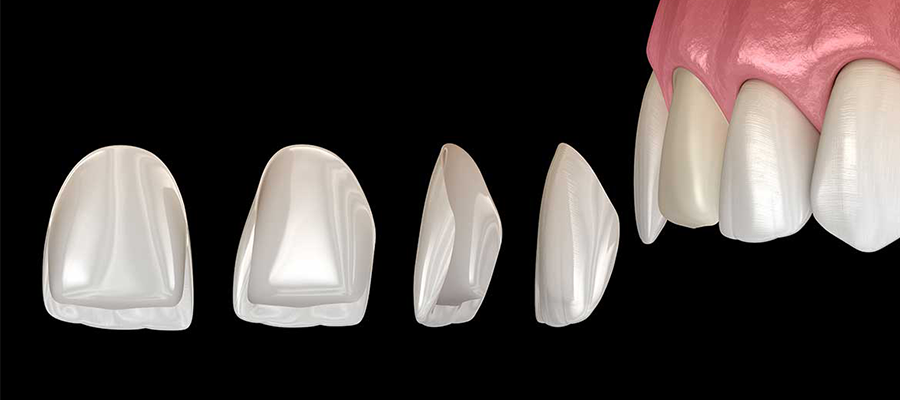 Thin porcelain veneer shells and their placement on front teeth
