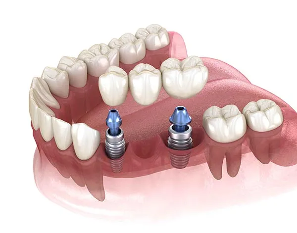 Three-tooth fixed bridge supported by two dental implants