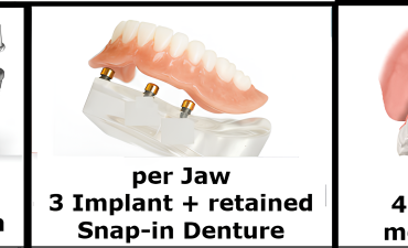 Implant supported Restorations